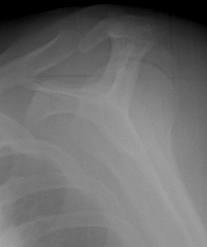 Displaced Greater Tuberosity Fracture Lateral